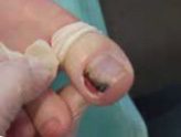 PodoVenlo - partiële nagelresectie 1